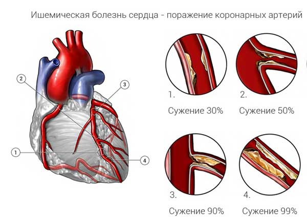 Контрольная работа по теме Заболевание сердца и сосудов