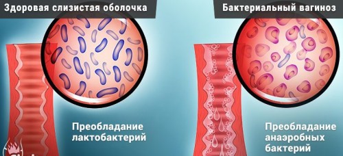 Гарднереллез (дисбиоз влагалища, бактериальный вагиноз)