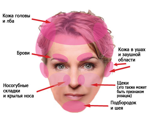 Лечение себорейного дерматита кожи головы