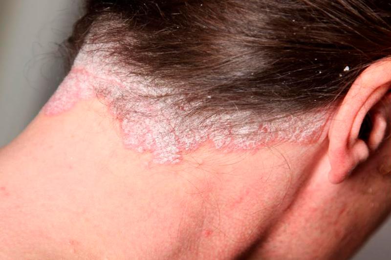Лечение себореи кожи головы в минске